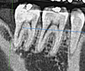 歯科用CT