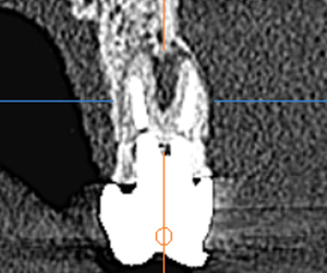 歯科用CT