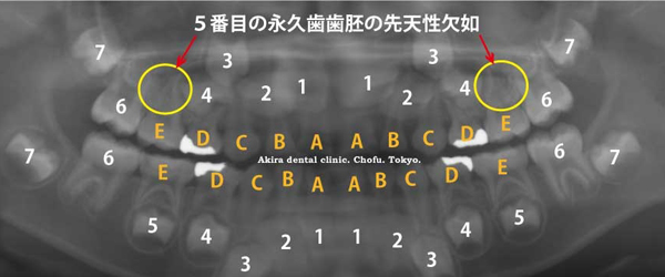 永久歯が生えてこない