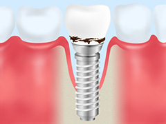 インプラント
