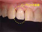 抜歯即時インプラント