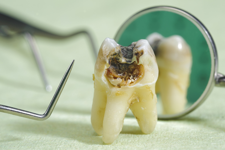 歯根破折の原因