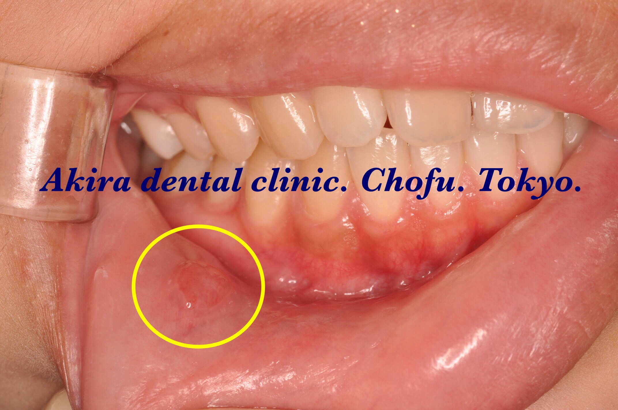 な 透明 の 物 出来 中 口 こんな歯茎の水ぶくれは危険！誰でもわかる歯茎の水ぶくれ・水疱・できもの診断
