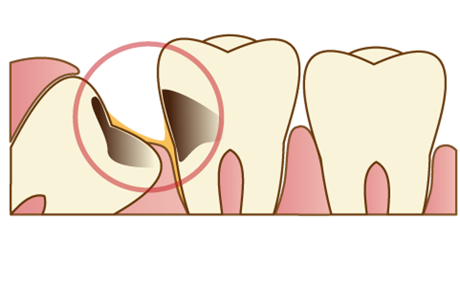 隣の歯にぶつかって生えている親知らず