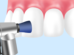 歯面を掃除