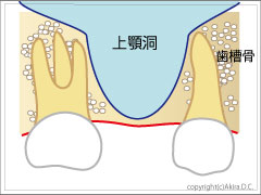 ソケットリフト法術前