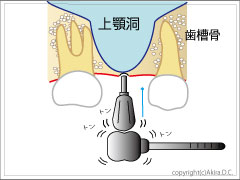 骨を叩き上げ