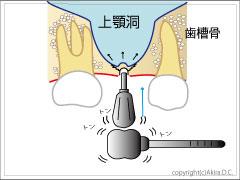 粘膜を押し上げ