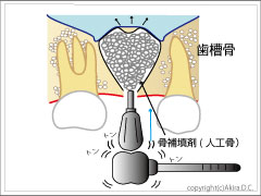 骨補填剤を填入