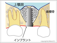 インプラント埋入