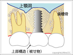 被せ物装着