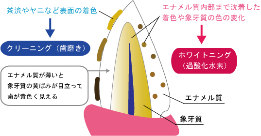 ホワイトニングとクリーニングの違い