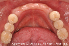 インプラント上部構造