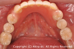下顎前歯部にValplast Denture(金属金具の無い弾性ある入れ歯）を装着