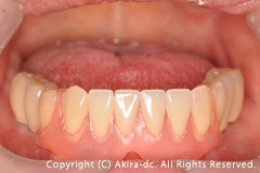 下顎前歯部にValplast Denture(金属金具の無い弾性ある入れ歯）を装着