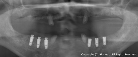 インプラント手術後のレントゲン写真