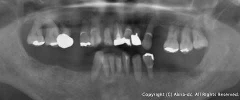 初診時抜歯前のレントゲン