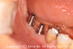 インプラントの土台が入りました