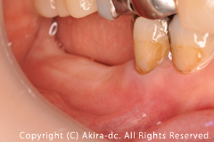 術前写真　臼歯2歯の欠損状態