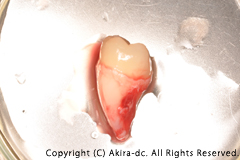 移植歯(親知らずを抜歯します)