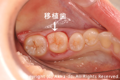 移植歯(親知らずを抜歯します)