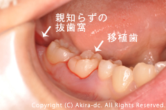 移植歯(親知らずを抜歯します)