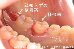 移植歯(親知らずを抜歯します)