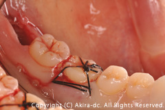 移植歯の調整と保定: 移植歯を適性なサイズに調整して、縫合糸にて保定します。