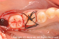 移植歯の調整と保定: 移植歯を適性なサイズに調整して、縫合糸にて保定します。