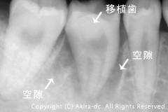 移植手術直後レントゲン写真