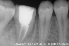 根管充填終了後レントゲン写真 (根の治療終了後) 術後2ヶ月