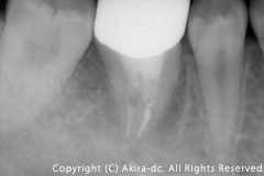補綴物(被せ物)装着完了後レントゲン写真 術後3ヶ月