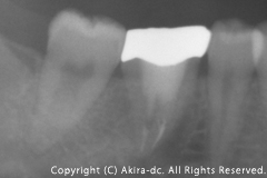 術後1年経過レントゲン写真