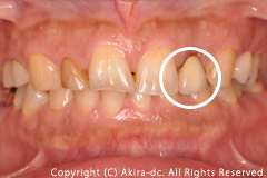 初診時口腔内写真