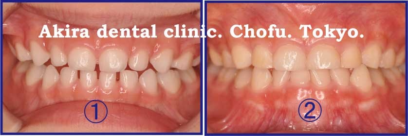 乳歯の発育空隙 調布市の歯科 歯医者ならあきら歯科 柴崎駅改札正面