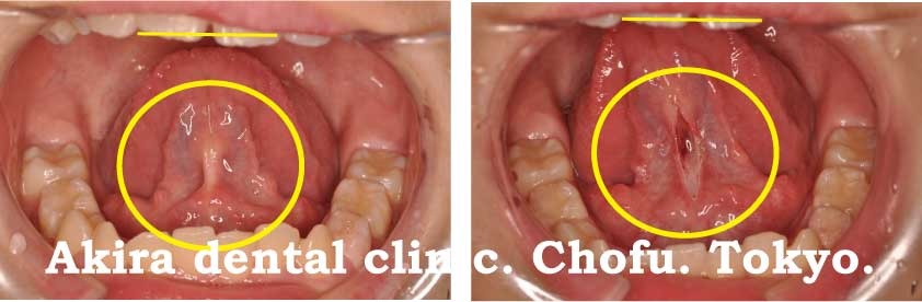 短い舌 舌小帯短縮症 だとどうなるの 調布市の歯科 歯医者ならあきら歯科 柴崎駅改札正面