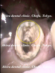 垂直歯根破折歯の口腔外接着再植法