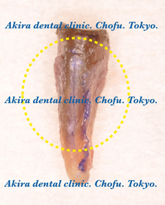 垂直歯根破折歯の口腔外接着再植法