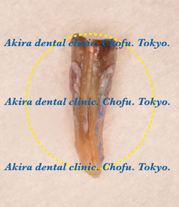 垂直歯根破折歯の口腔外接着再植法