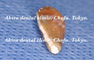垂直歯根破折歯の口腔外接着再植法