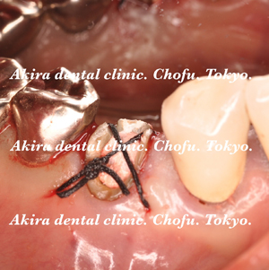 垂直歯根破折歯の口腔外接着再植法