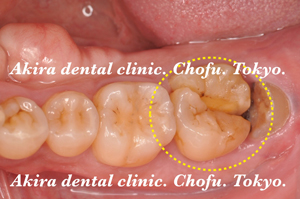 患者様の声 親知らず・歯の移植・自家歯牙移植編 Tooth