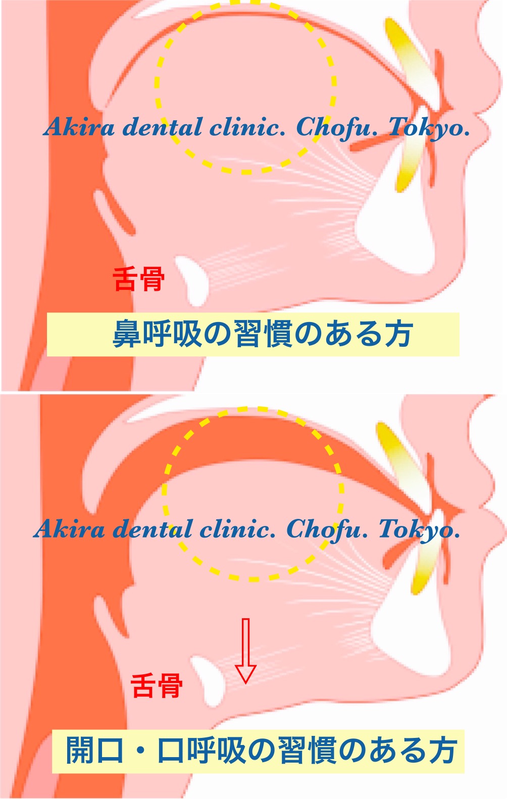 ガムを舌で丸めることできますか できなければ低位舌かも ガムトレーニングで舌を鍛えましょう 調布市の歯科 歯医者ならあきら歯科 柴崎駅改札正面