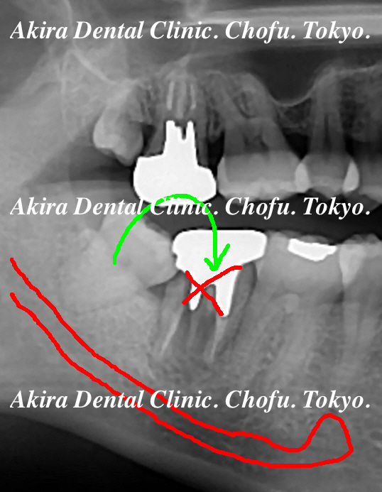 患者様の声 親知らず・歯の移植・自家歯牙移植編 Tooth