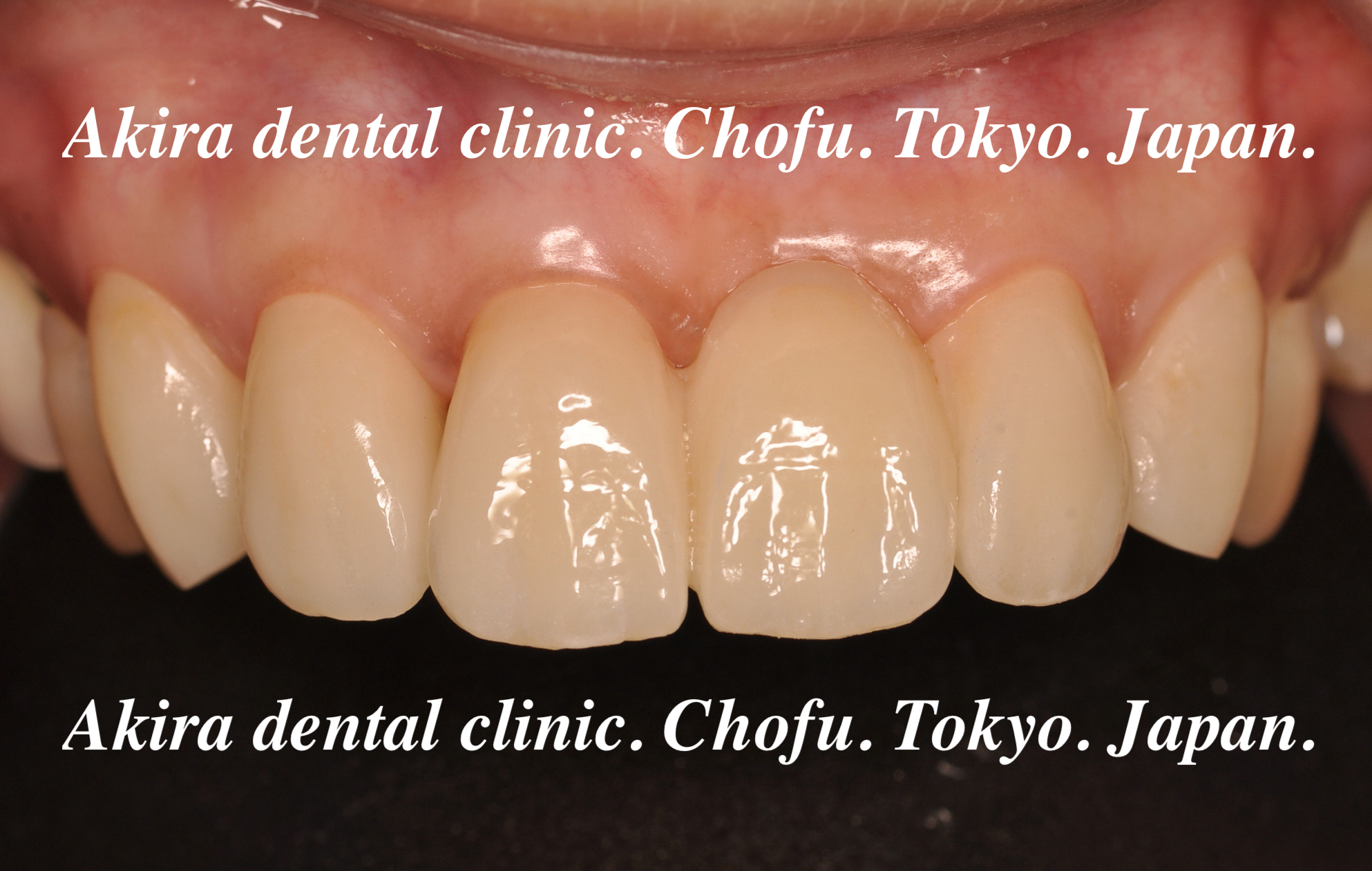【美品】 審美歯科治療編 女性 40代 ) treatment dentistry (Aesthetic 健康・医学