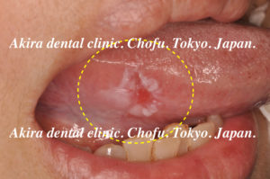 舌 ベロ の下に痛みや違和感があり口内炎かと思ったら 我慢せず早期に歯科医院での受診をお勧めします If You Think That It Has Pain Or Discomfort Under The Tongue And You Think It Is A Stomatitis I Will Recommend Doing A Doctor S Examination At An Early