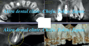 前歯部抜歯即時インプラント治療編