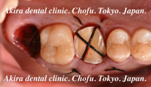 患者様の声 : 親知らず・歯の移植・自家歯牙移植編（上顎洞挙上術併用
