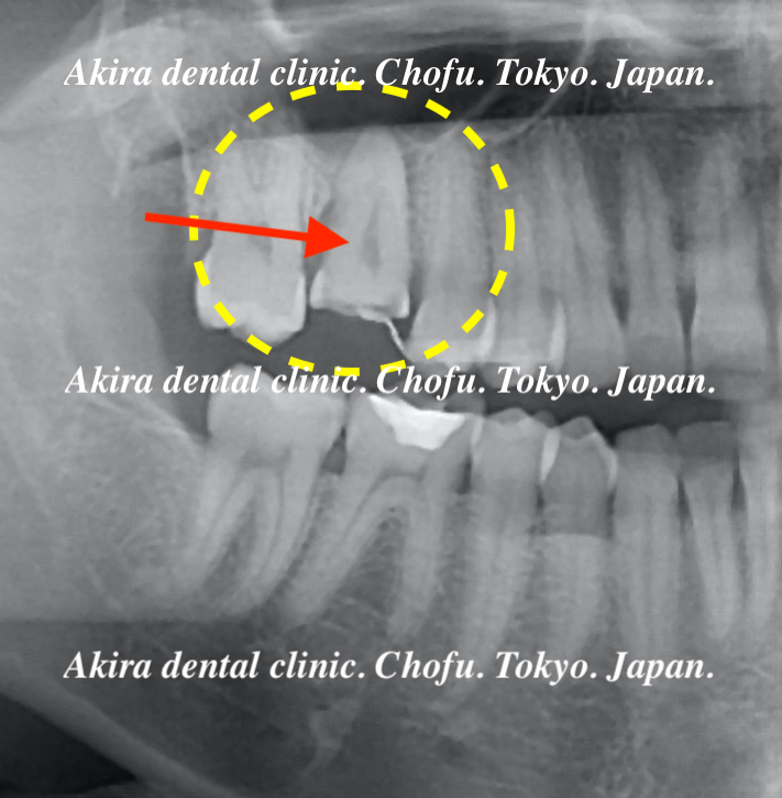 患者様の声 : 親知らず・歯の移植・自家歯牙移植編（上顎洞挙上