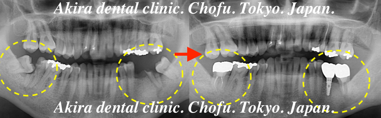 患者様の声 : 親知らず・歯の移植・自家歯牙移植編 Tooth